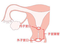 「子宮頸管が短いと切迫早産になりやすい」...