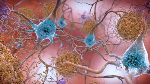 Beta-Amyloid Plaques and Tau in the Brain, From FlickrPhotos